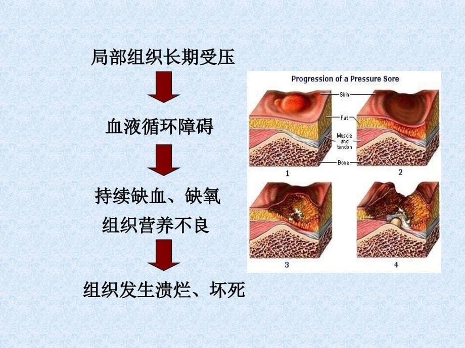 压疮预防及护理幻灯片_第5页