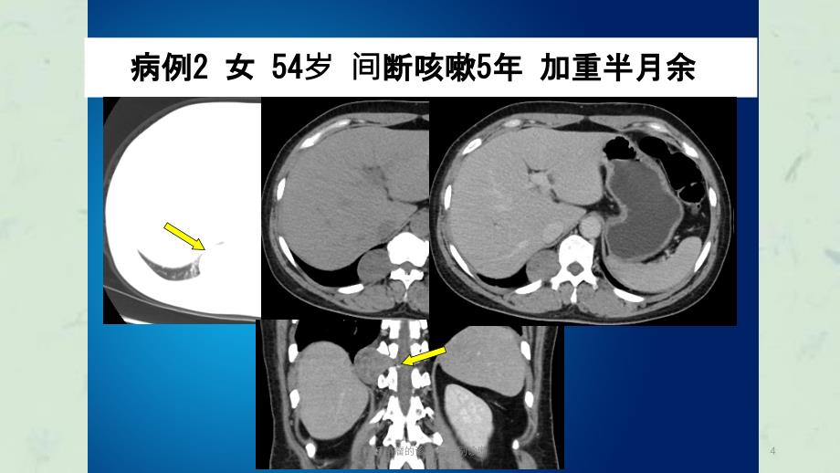 胃神经鞘瘤的诊断与鉴别诊断课件_第4页