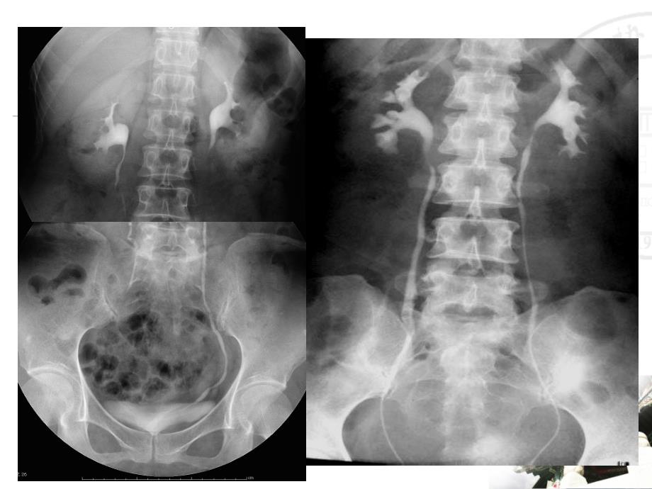 医学影像学课件：泌尿生殖系统正常及异常影像学表现_第3页