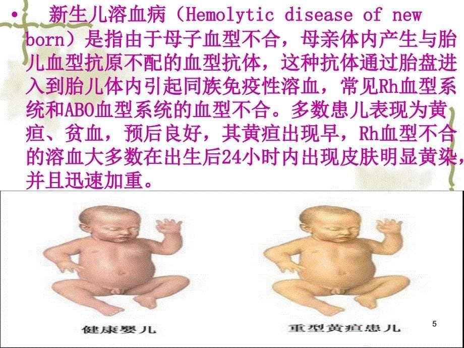 新生儿溶血性黄疸的护理ppt课件_第5页