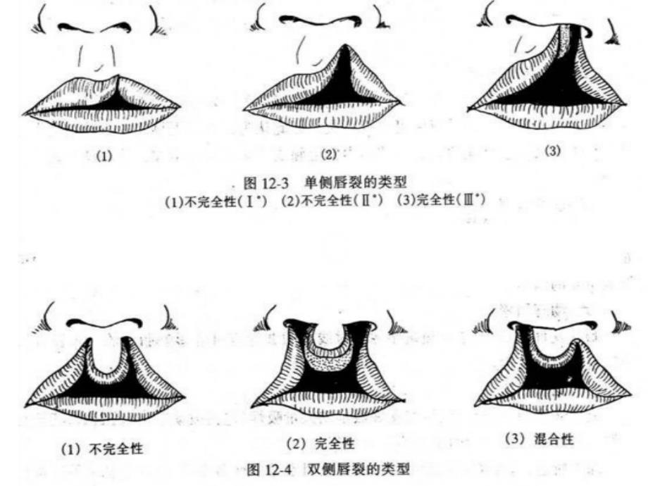 唇裂术后护理查房课件_第4页