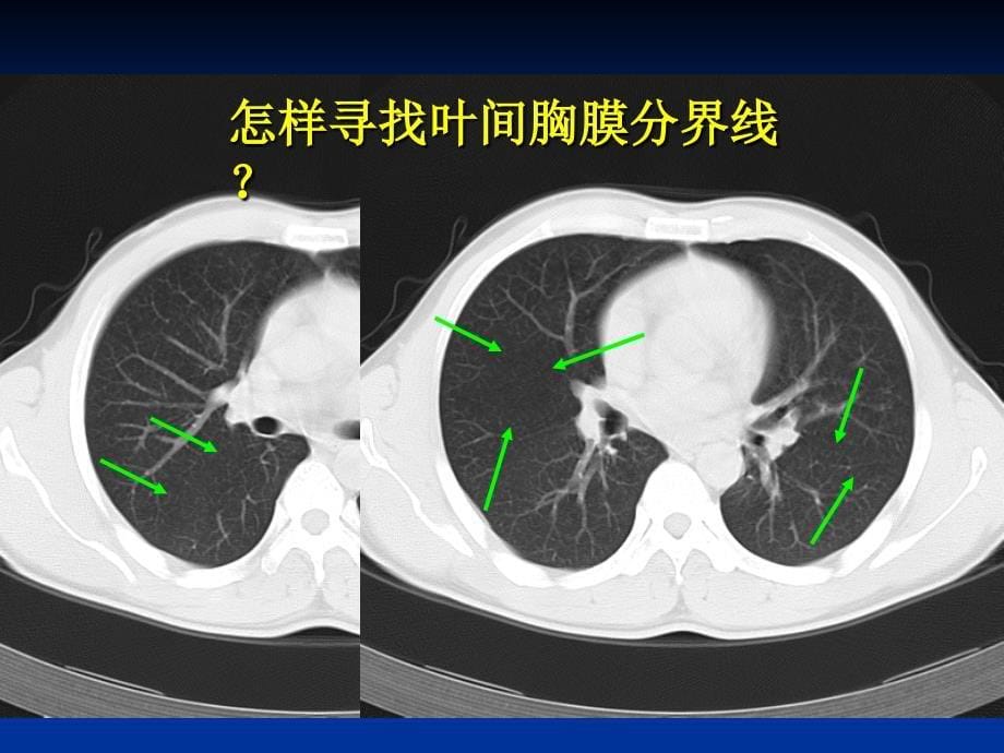 肺的分叶分段课件.ppt_第5页