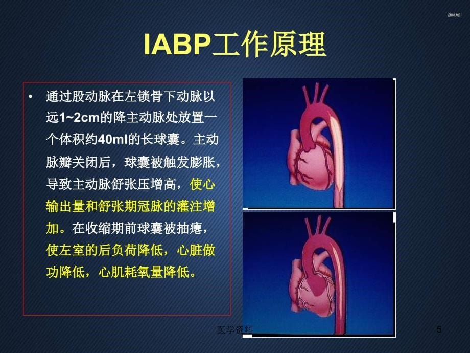 IABP和辅助循环装置在危重冠心病人的应用p课件_第5页