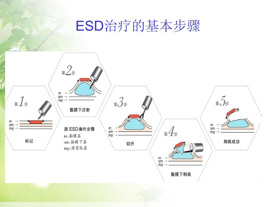 esd治疗早期胃癌PPT课件_第4页