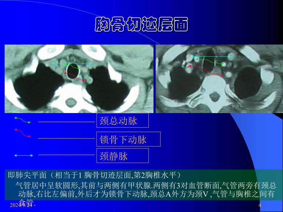 正常胸部CT断层PPT课件_第4页