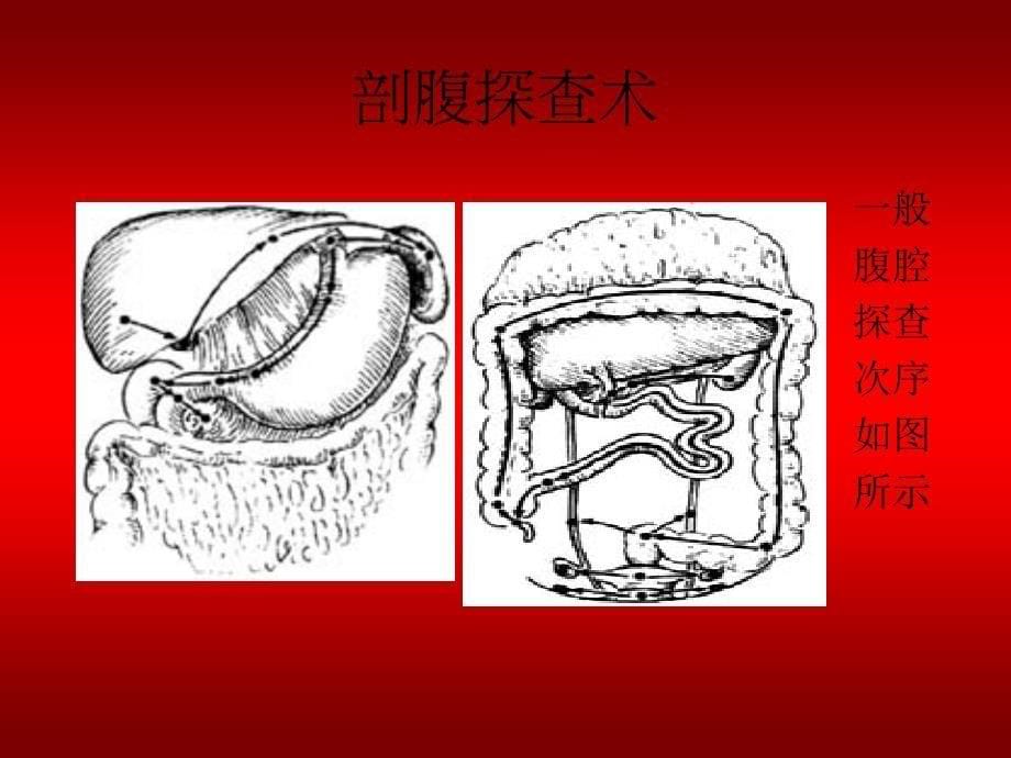 剖腹探查手术图解_第5页