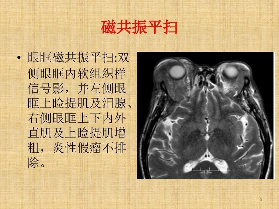 眼眶炎性假瘤ppt课件_第5页