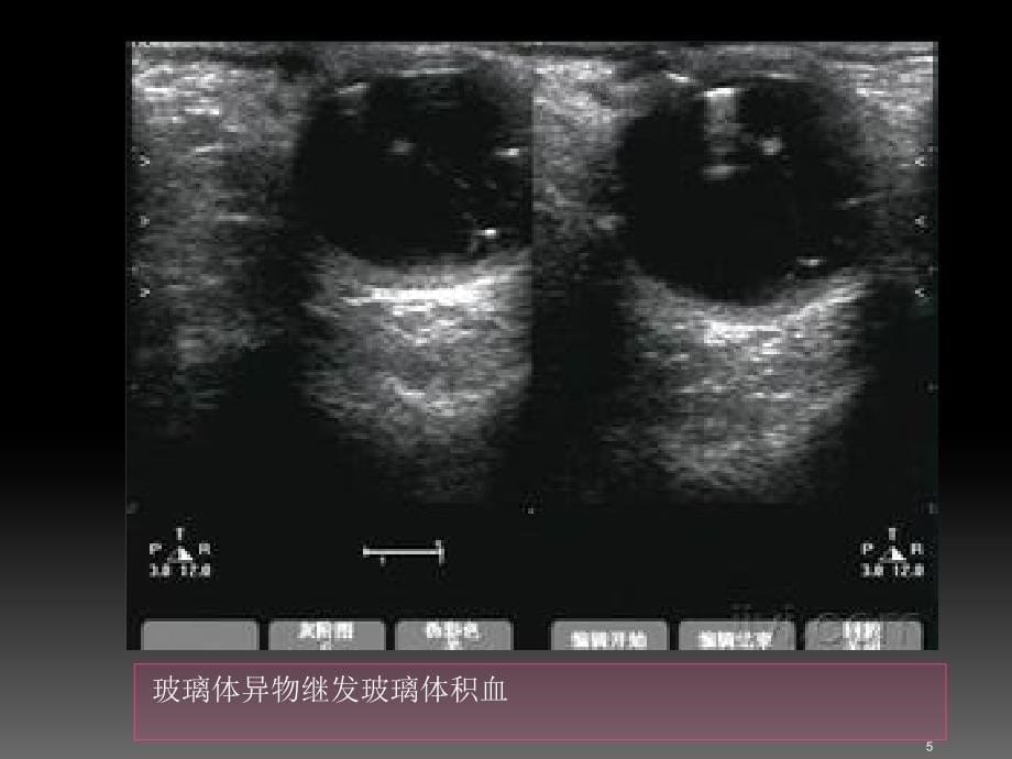 玻璃体积血患者的护理PPT参考幻灯片_第5页