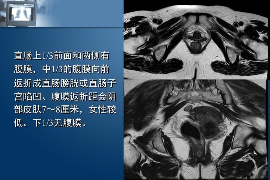 直肠癌术前MR分期课件_第5页