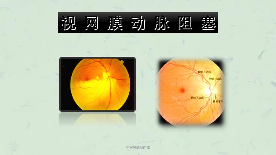 视网膜动脉阻塞课件_第1页