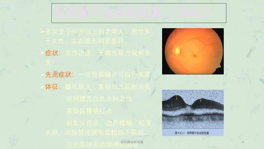 视网膜动脉阻塞课件_第4页