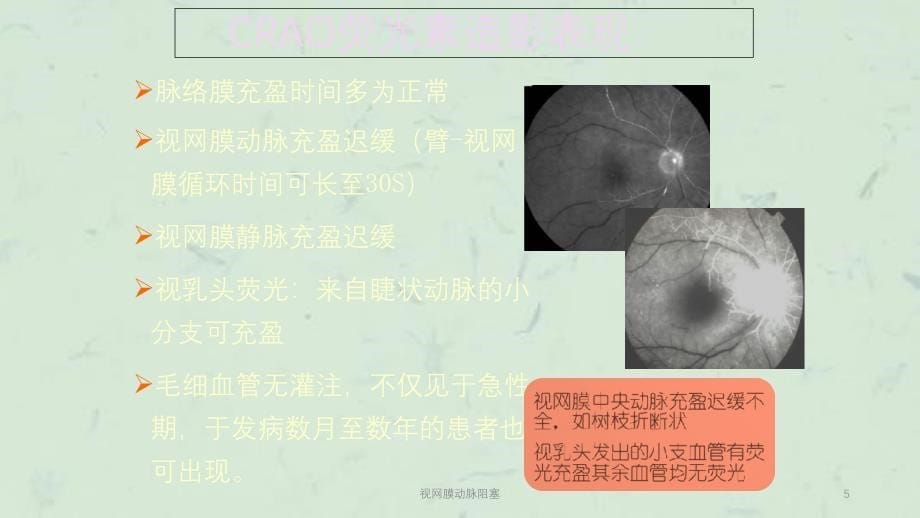 视网膜动脉阻塞课件_第5页