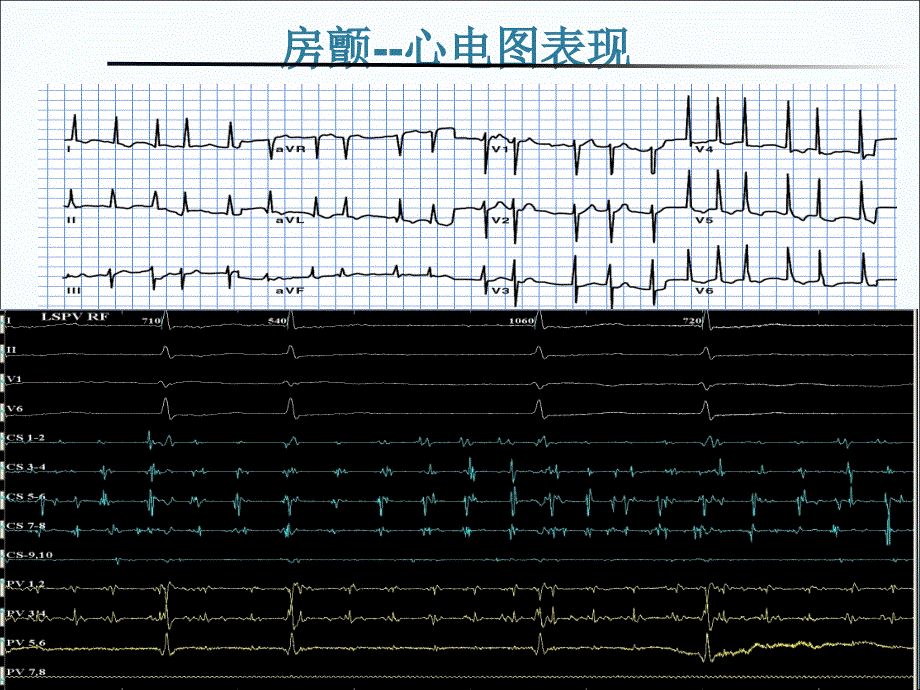 （优质课件）房颤的导管消融治疗_第3页