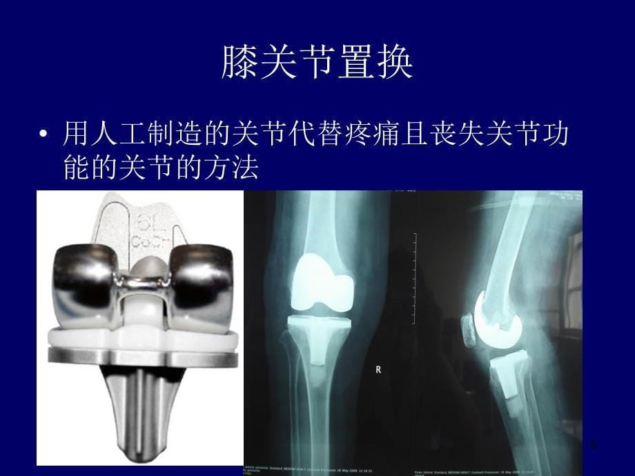 膝关节置换术后ppt课件_第5页