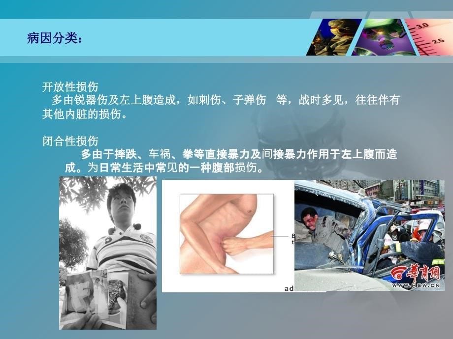 脾破裂护理查房PPT课件_第5页