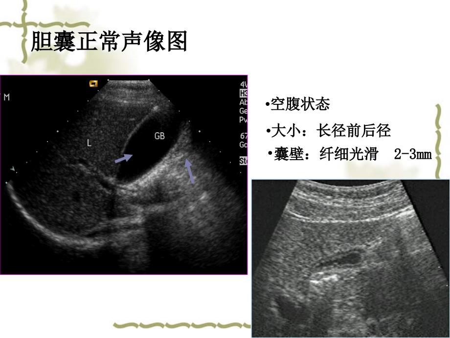 胆囊超声诊断PPT课件_第4页