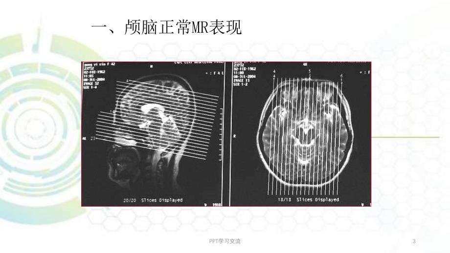 磁共振成像诊断MRI脑部疾病课件_第3页