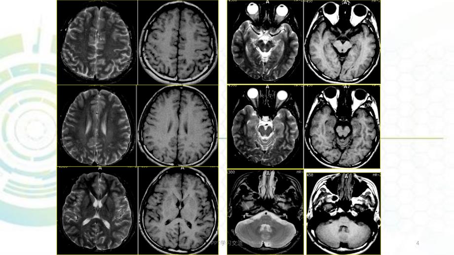 磁共振成像诊断MRI脑部疾病课件_第4页