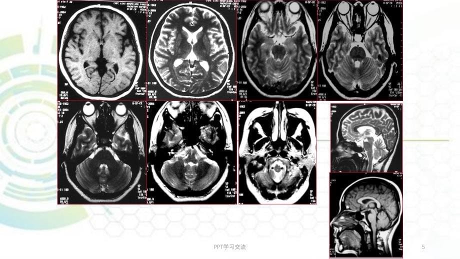 磁共振成像诊断MRI脑部疾病课件_第5页