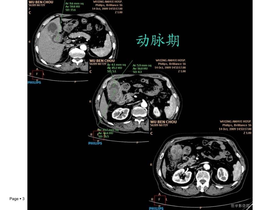 黄色肉芽肿性胆囊炎_第3页