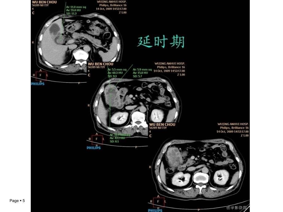 黄色肉芽肿性胆囊炎_第5页