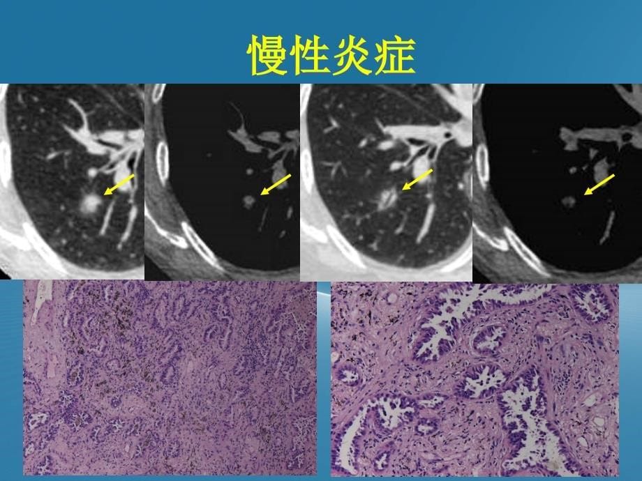 肺磨玻璃结节的CT诊断与随访ppt课件_第5页