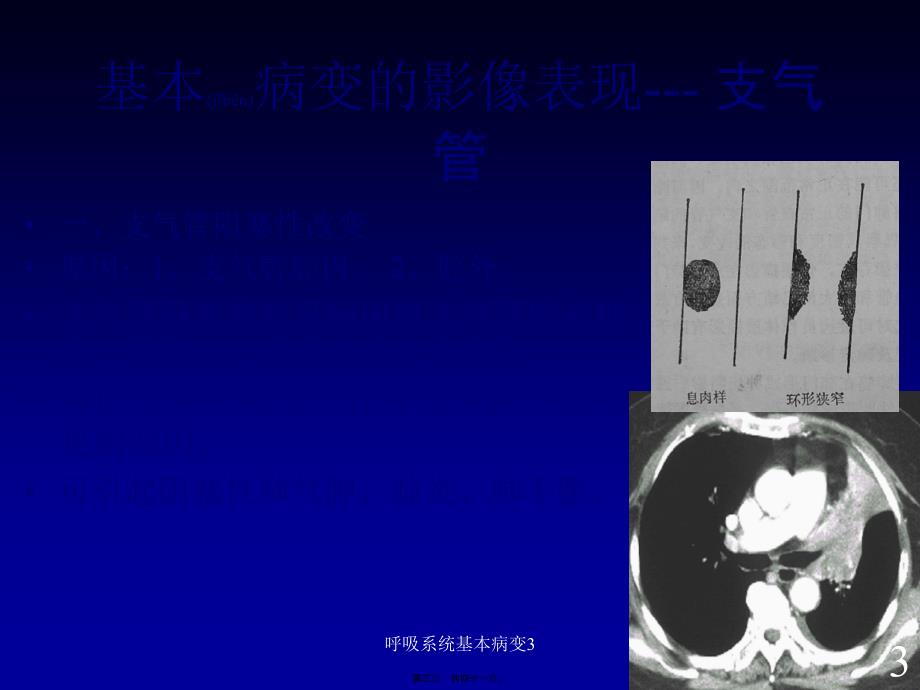 呼吸系统基本病变3课件_第3页