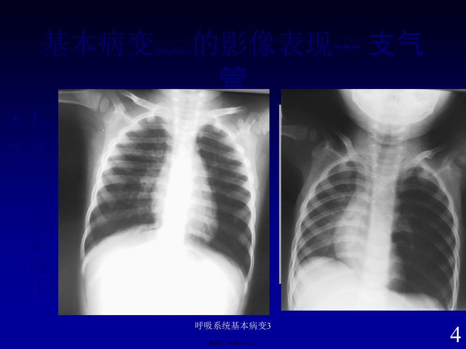 呼吸系统基本病变3课件_第4页