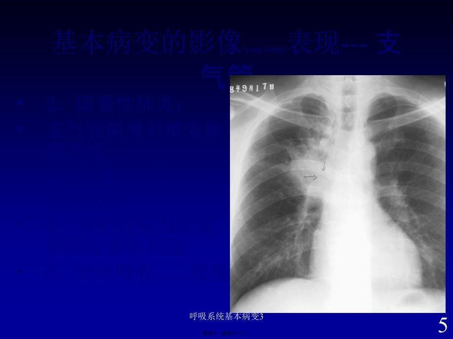 呼吸系统基本病变3课件_第5页