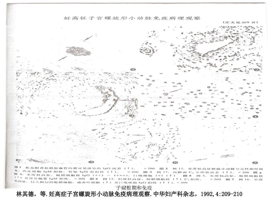 子痫前期和免疫课件_第4页