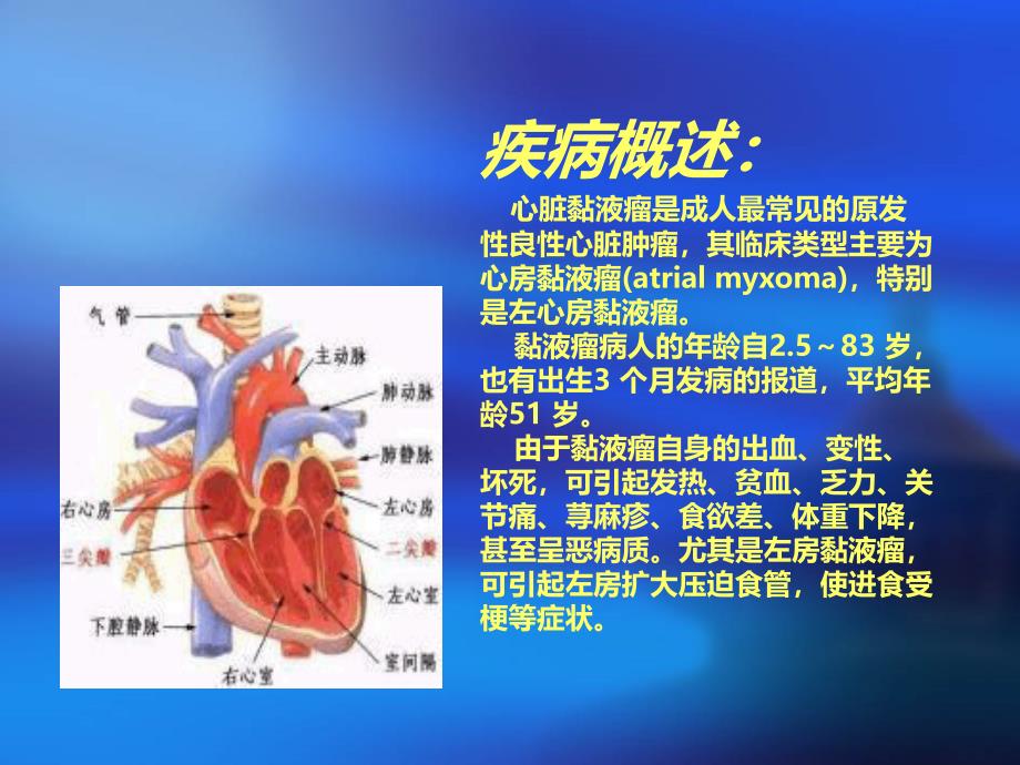 心脏黏液瘤PPT课件_第3页