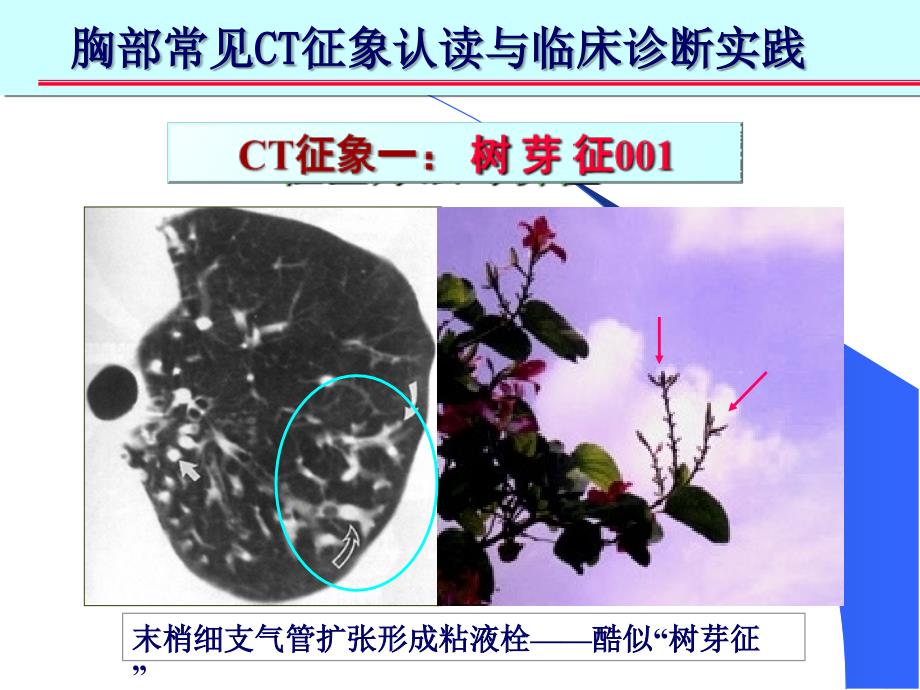 肺部CT十大征象诊断应用完整版_第4页