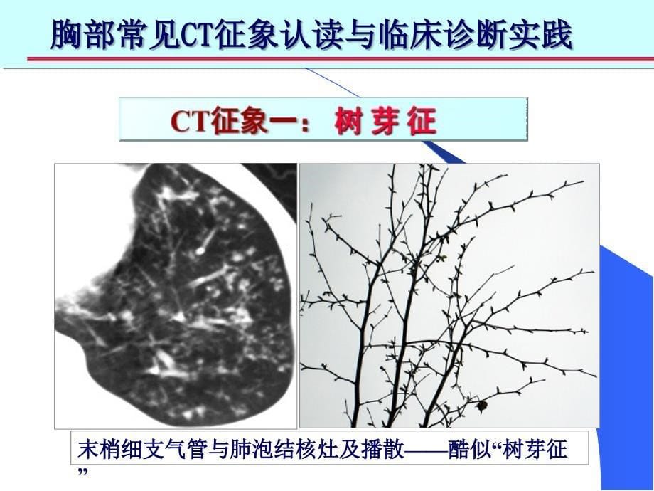 肺部CT十大征象诊断应用完整版_第5页