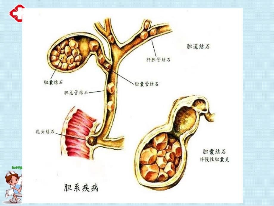 胆道疾病患者的护理ppt.ppt_第4页