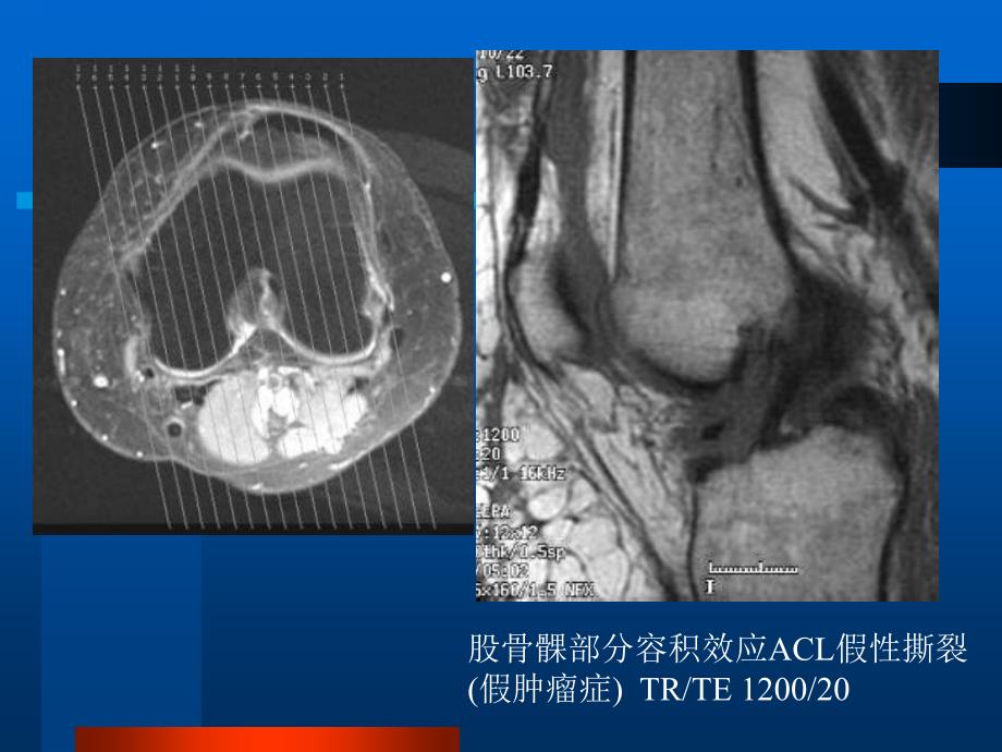 膝关节韧带损伤的MRI诊断资料讲解_第4页