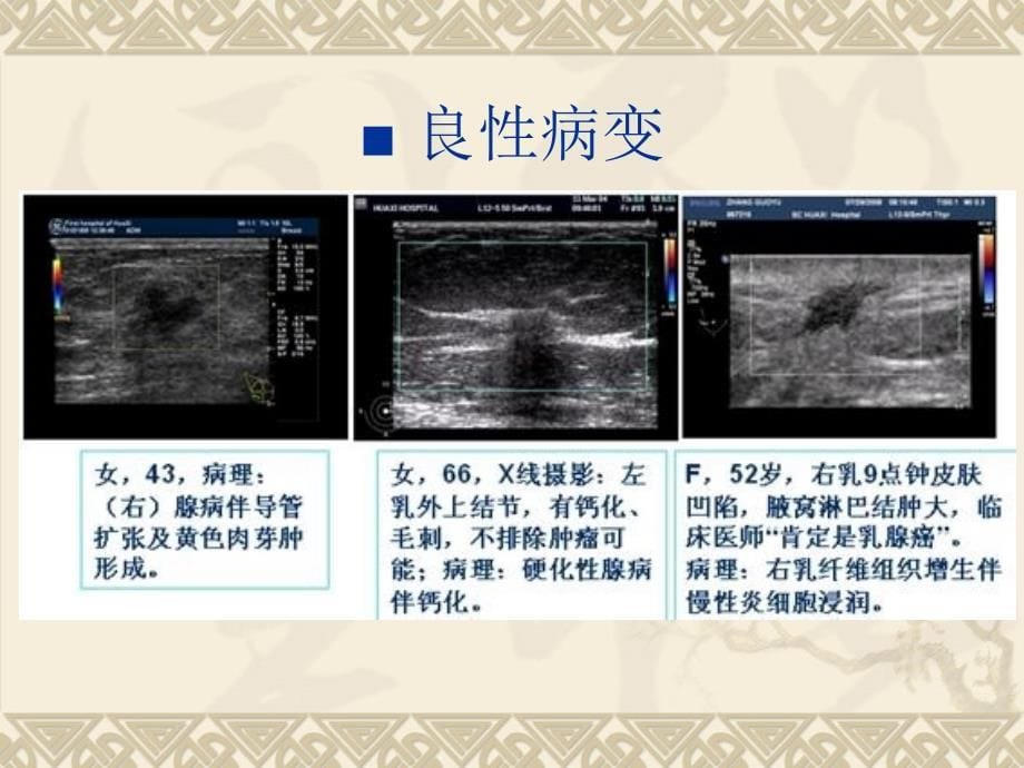 乳腺超声弹性成像_第5页