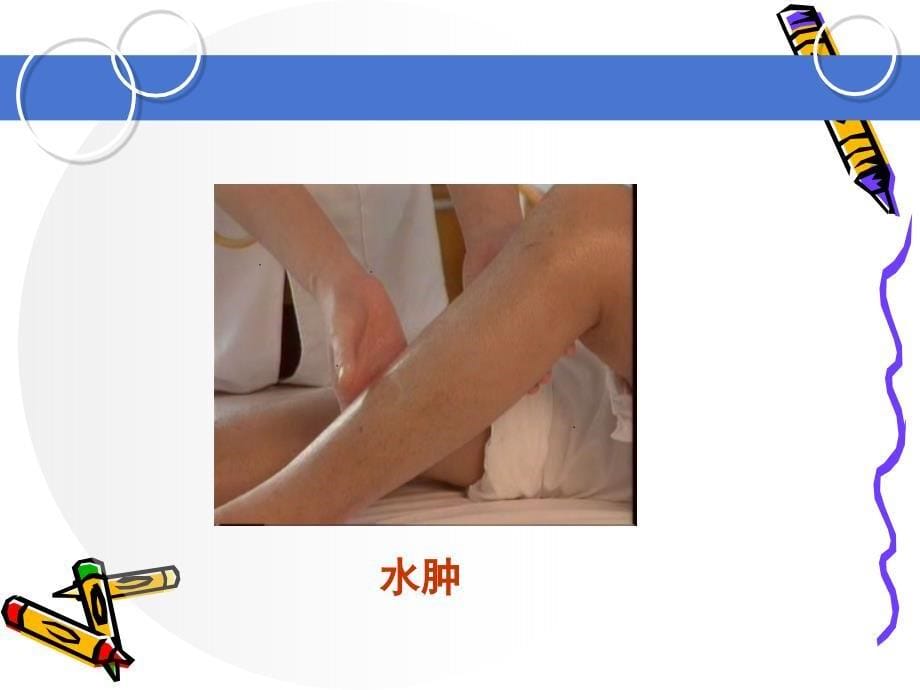 肾病综合征患者的护理.ppt_第5页