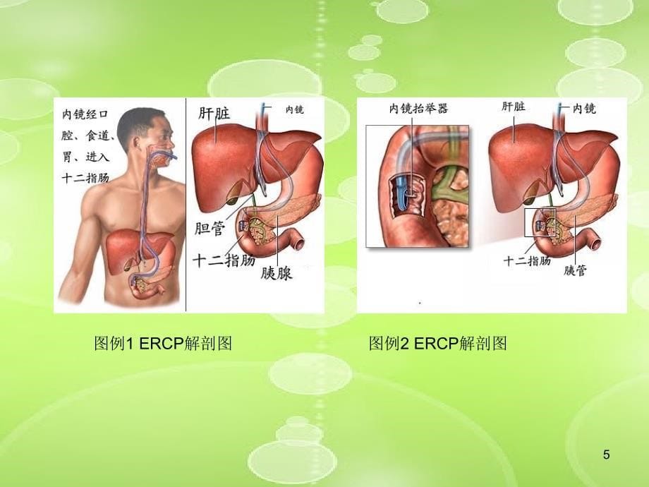 ERCP术前与术后护理PPT参考幻灯片_第5页