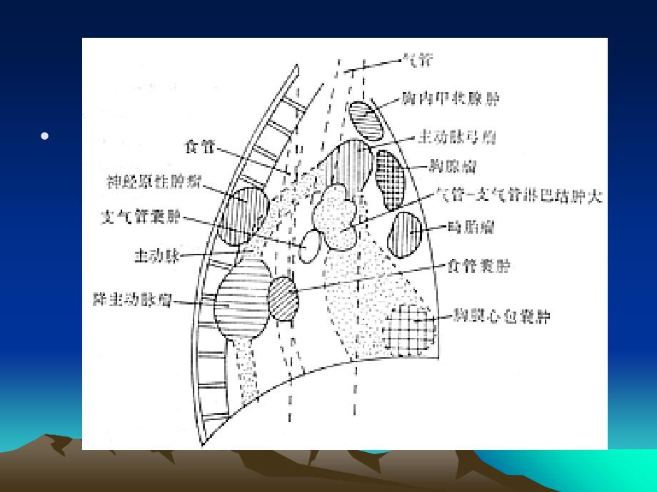 《纵隔肿瘤影像诊断》PPT课件_第4页