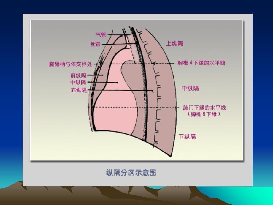 《纵隔肿瘤影像诊断》PPT课件_第5页