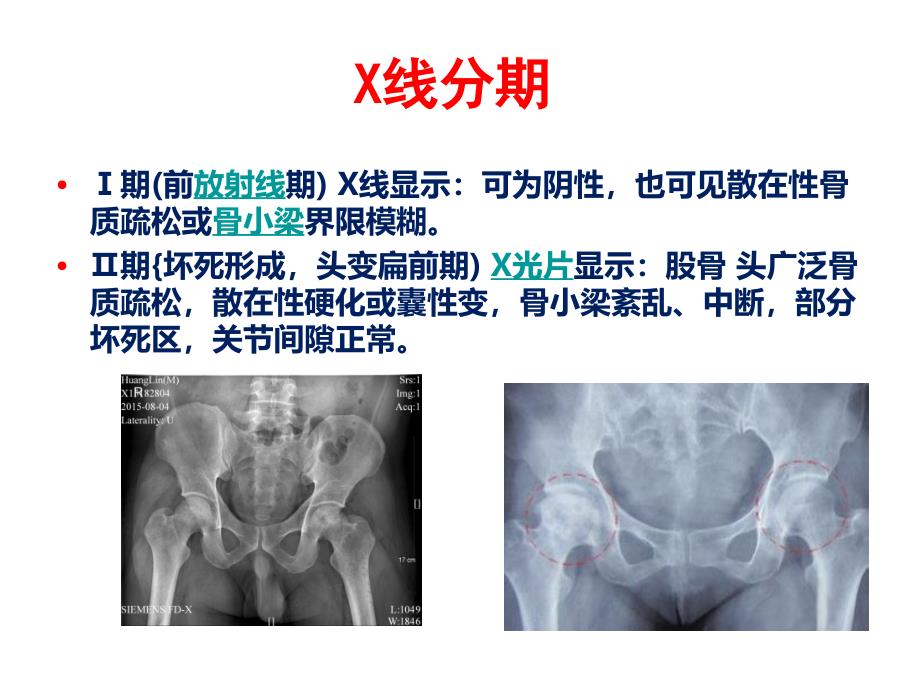 医学课件：61_股骨头缺血性坏死_第3页