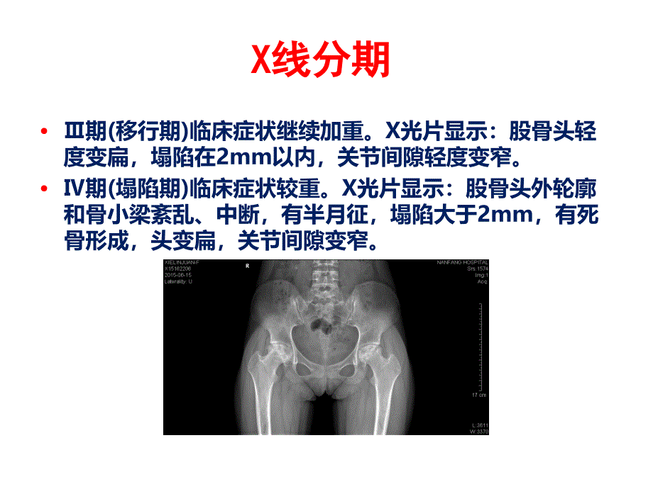 医学课件：61_股骨头缺血性坏死_第4页