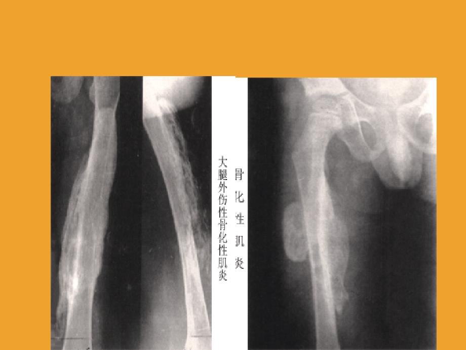 骨化性肌炎探讨课件_第2页