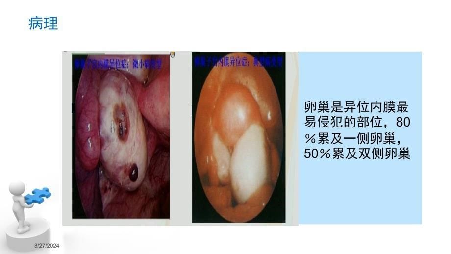 卵巢囊肿护理查房_第5页