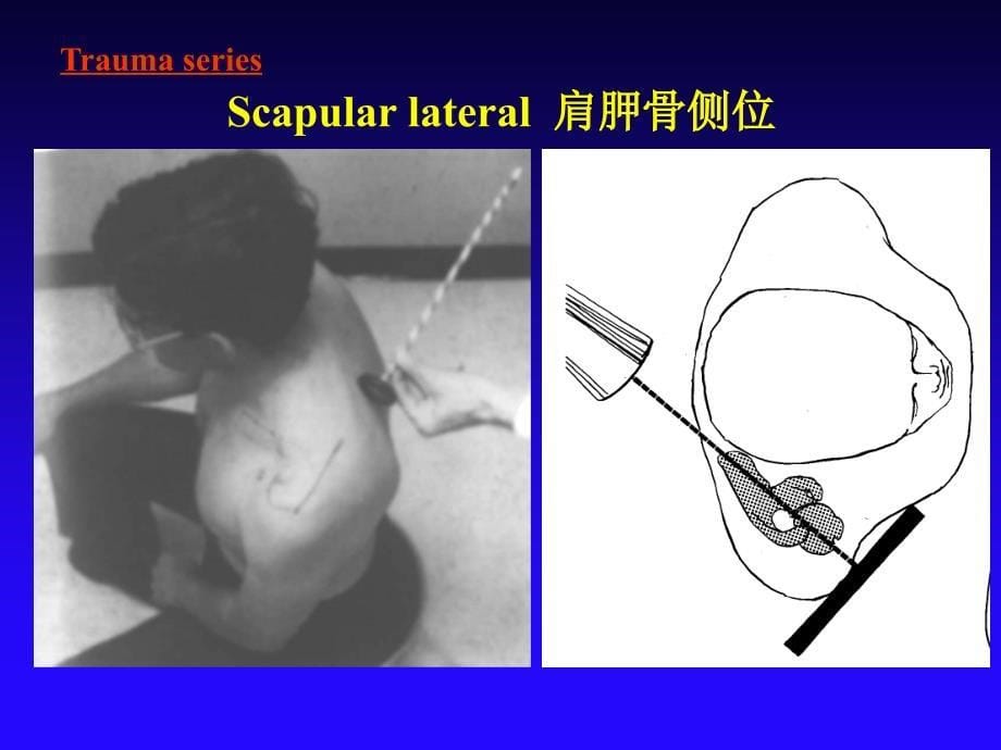 肩关节X线拍照方法ppt课件_第5页