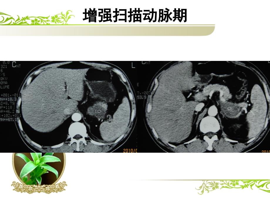 胰腺囊腺瘤影像诊断_第4页