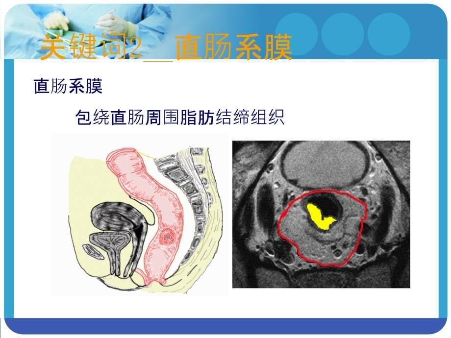 腹腔镜全直肠系膜切除术的实践和探讨_第5页