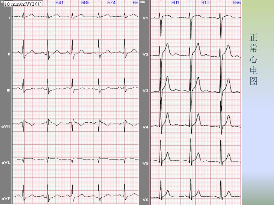 常见心电图识别_第4页