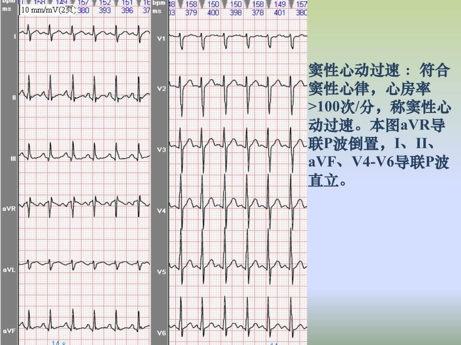 常见心电图识别_第5页