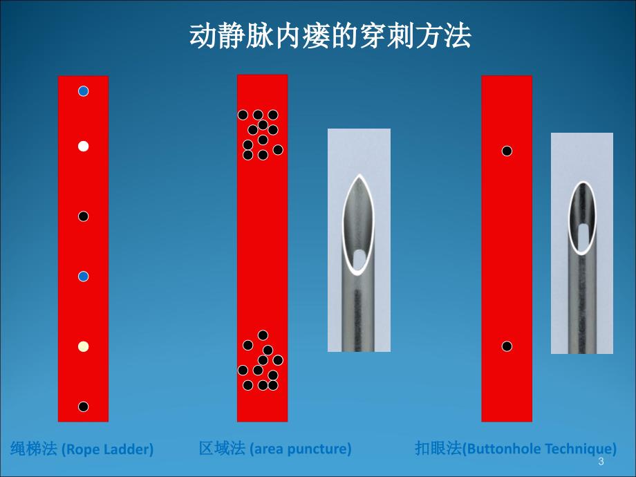 人工血管的绳梯穿刺PPT课件_第3页